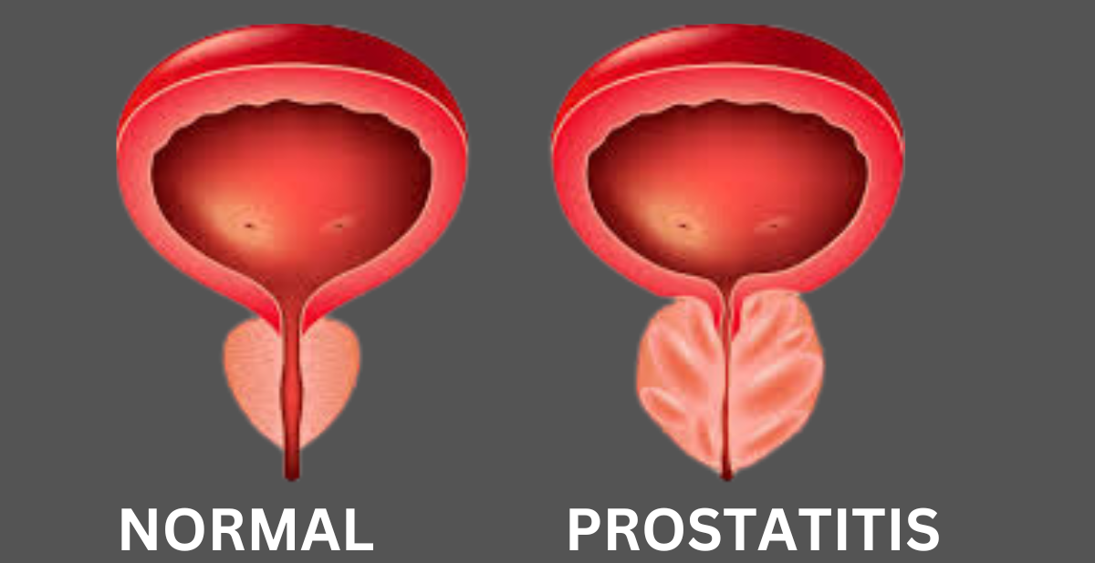 Chronic Prostatitis: Causes, Symptoms, Diagnosis, And Treatment